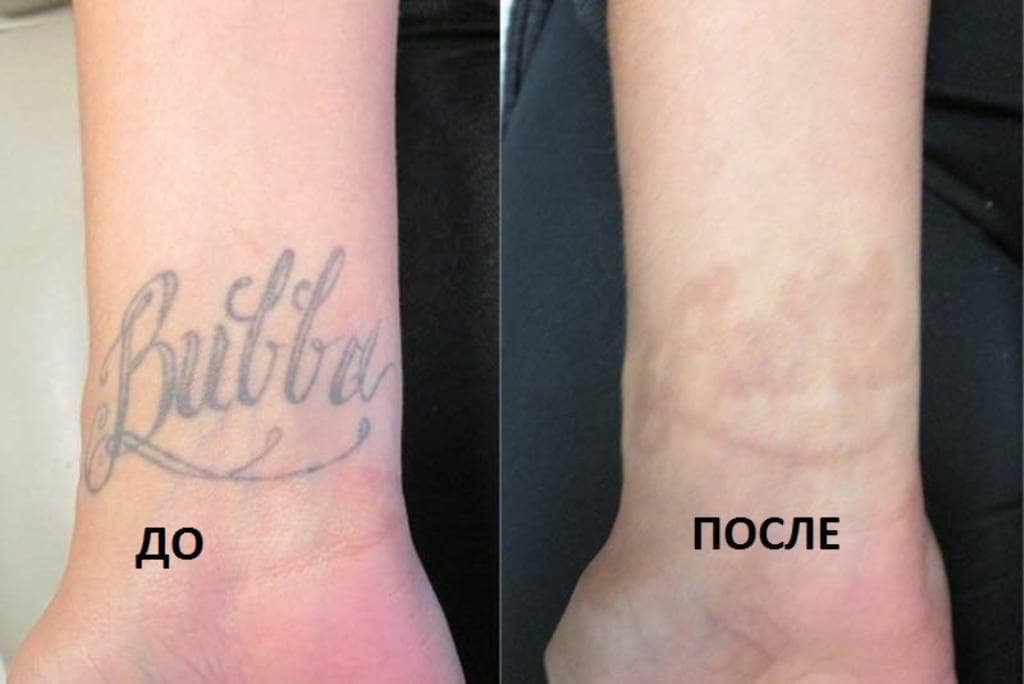 Удаление татуировок в Москве