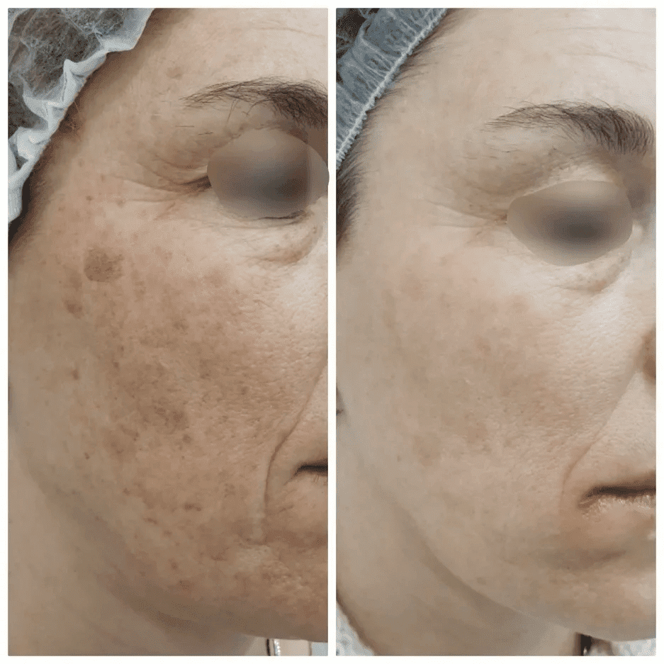Удаление пигментных пятен на лице