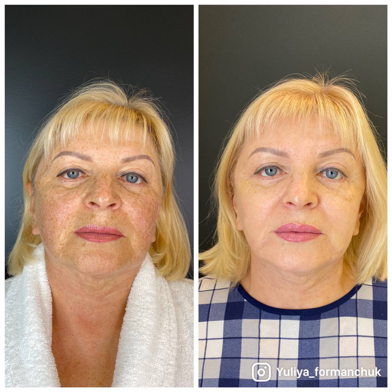 Плазмотерапия лица фото до и после