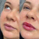 Делаете скулы? Получите губы — В ПОДАРОК!
