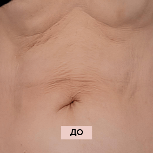 до после живот волньюмер1