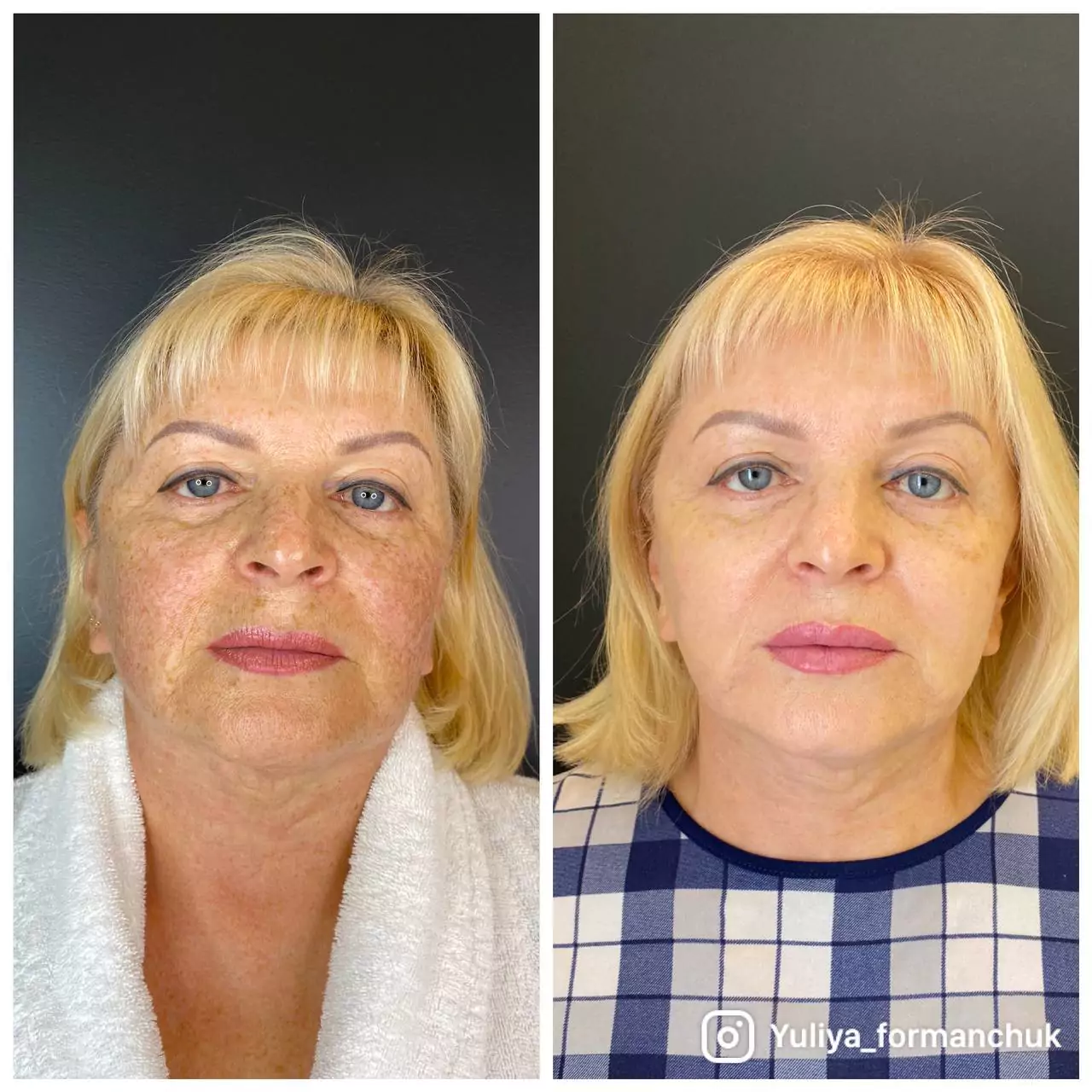 Плазмолифтинг отзывы фото до и после лицо. Плазмолифтинг для лица. Плазмолифтинг лица до и после. Плазмолифтинг для лица до и после фото. Плазмотерапия лица до и после.